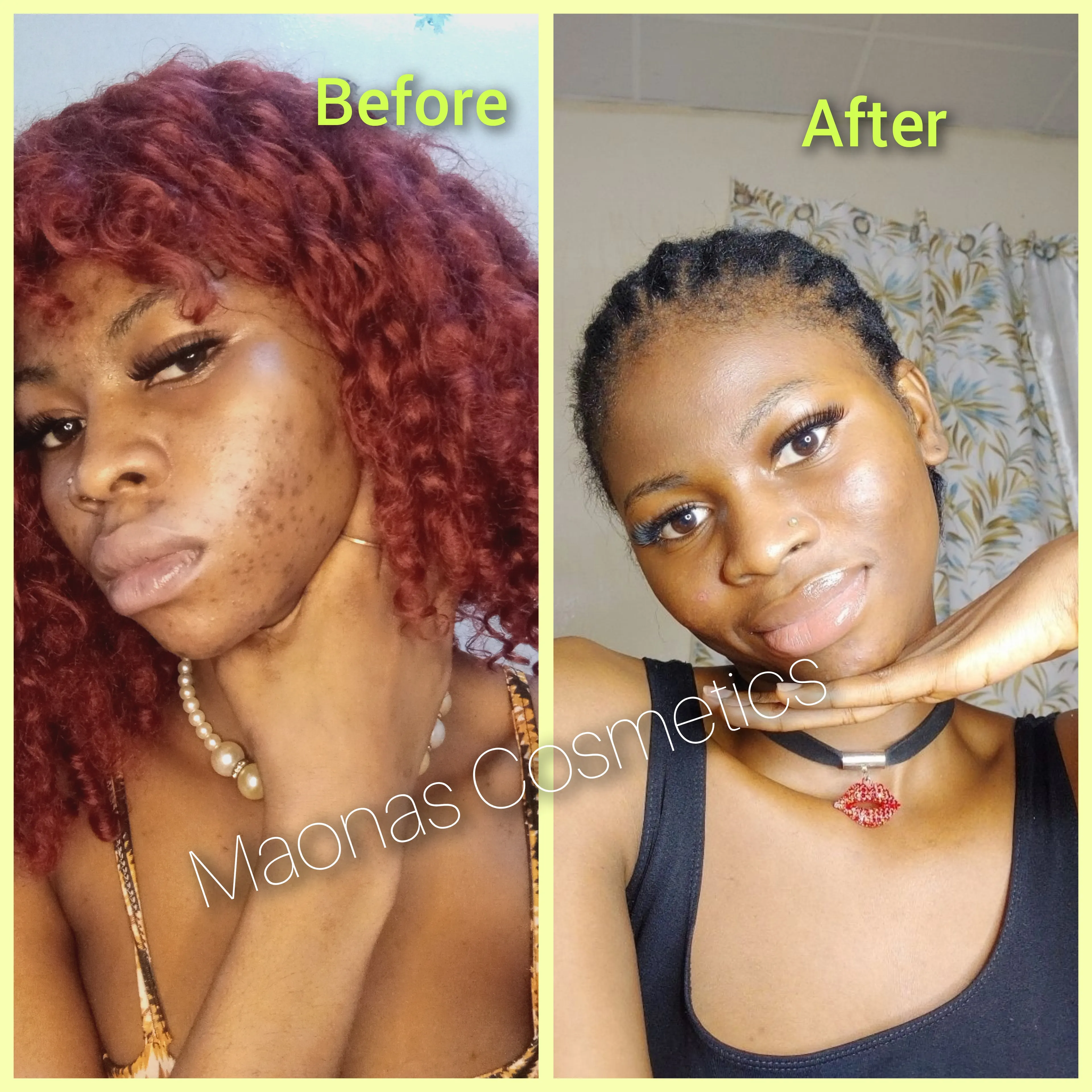 Hyperpigmentation