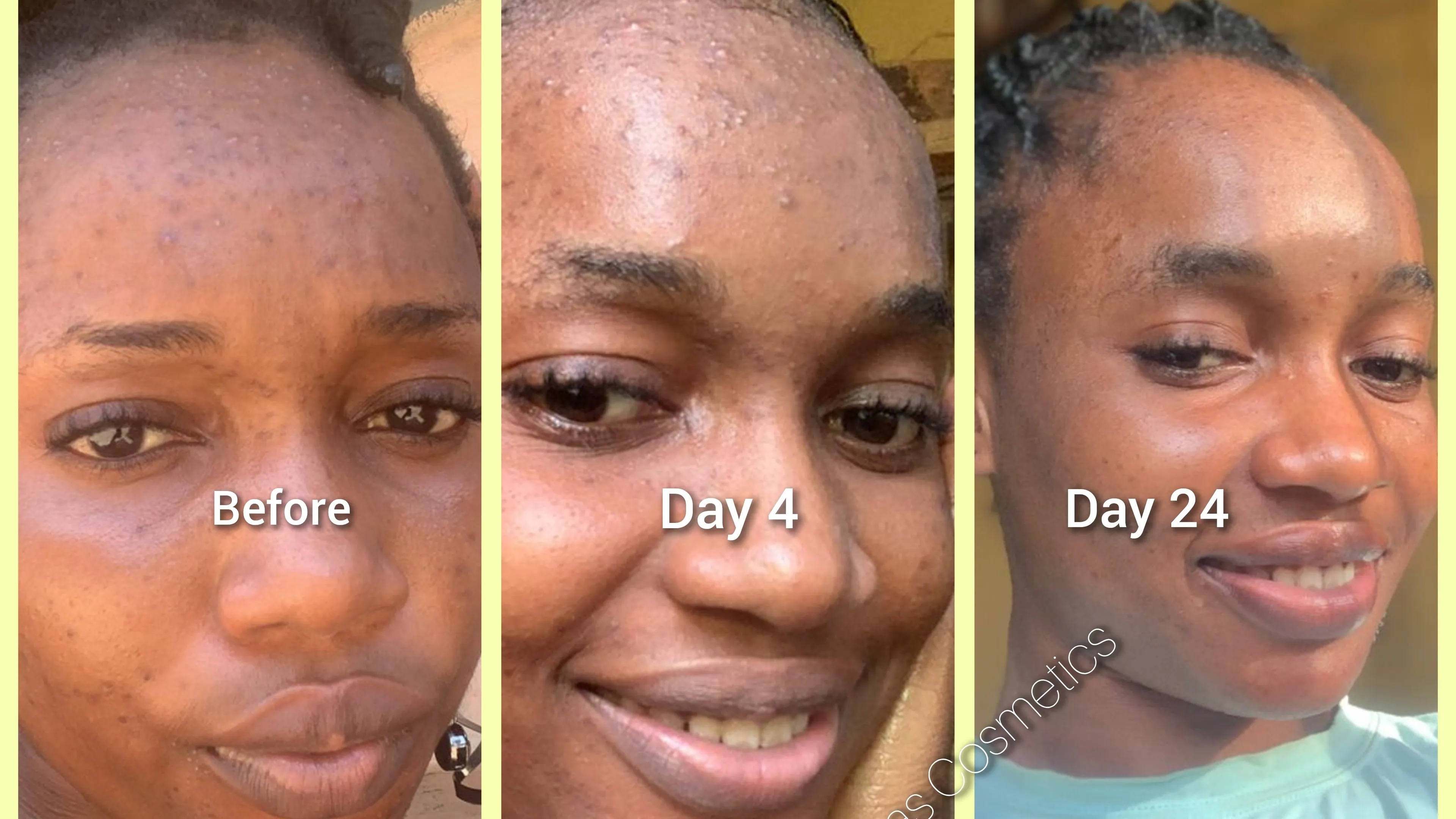 Acne/Rashes/Redness